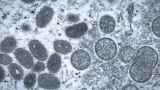 The Monkeypox Double Standard: Public Health Messaging About It Is Vastly Different from COVID-19