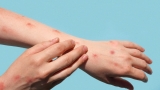 CDC confirms 3 monkeypox cases in Mississippi