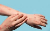 CDC director: Monkeypox may be tricky to diagnose