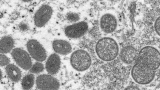 2nd presumed case of monkeypox in LA