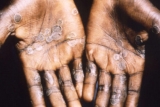 A case of monkeypox may be in Georgia. Here’s what you need to know