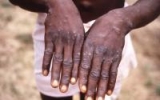 WHO focuses less on endemicity as global monkeypox cases top 2,500