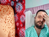 A sexual health worker shares his experience of Monkeypox: “I felt alone and the pain was unbearable”