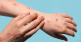 Monkeypox symptoms: ‘I literally screamed out loud in pain’.. Patient shares excruciating symptoms from his experience