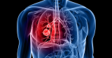 World Lung Cancer Day: Early symptoms of the cancer to watch out for