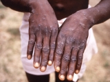 Monkeypox virus latest news: WHO ‘calls emergency meeting’ as UK cases double