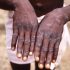 Health News – CDC investigating monkeypox in the U.S.