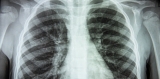How COVID can be diagnosed with X-rays