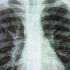 CDC no longer recommends universal COVID contact tracing