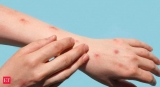 Monkeypox News: Monkeypox to be renamed by World Health Organization after scientists say the word is biased toward Africa