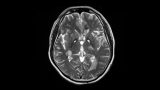 CDC Reports Two Cases of Monkeypox-Related Encephalomyelitis