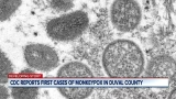 CDC reports first cases of monkeypox in Duval County – ActionNewsJax.com