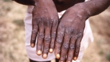 Monkeypox: What to know about the virus detected in the United States