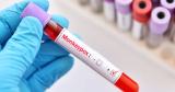 Georgia health officials confirm second monkeypox case in the state