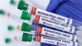 Opinion | Monkeypox is spreading quickly and should be declared a pandemic