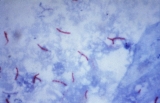 After COVID, India tries to get on top of tuberculosis