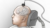 Brain Implant Transforms Thoughts Into Words On Computer Screen : Shots