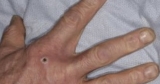 CDC confirms monkeypox in Hawaiʻi. Third probable case identified