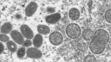 Monkeypox: Canadian heading WHO’s fight against virus
